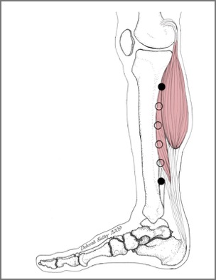 Medial shin splintsjpg